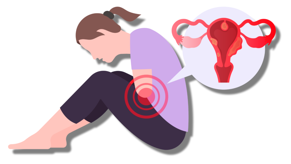 Endometriosis Treatment