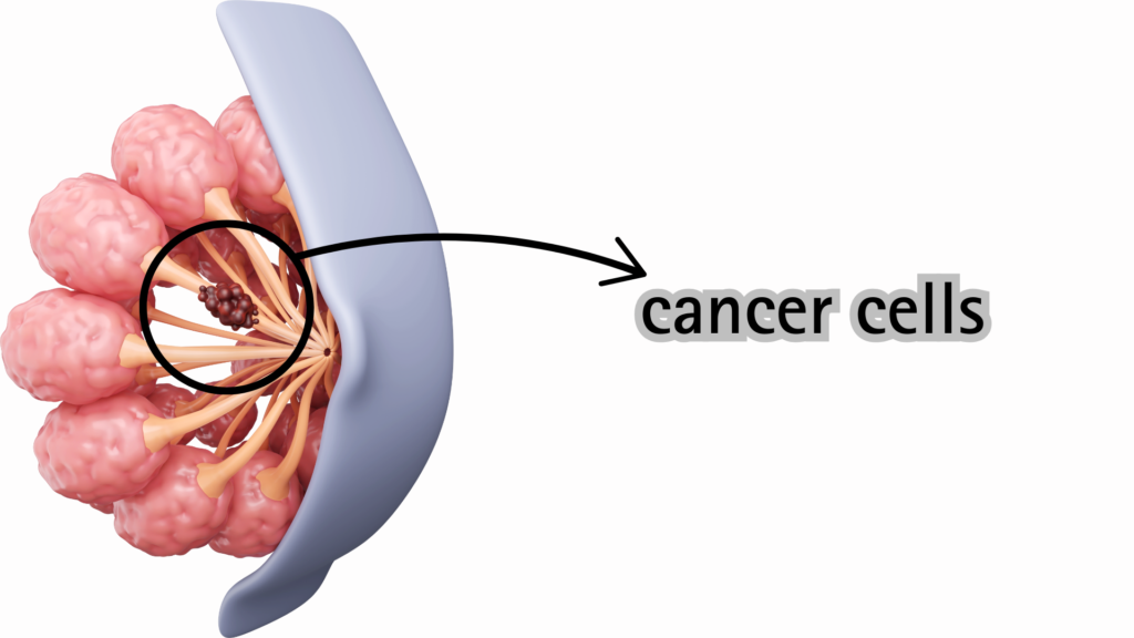 what is breast cancer